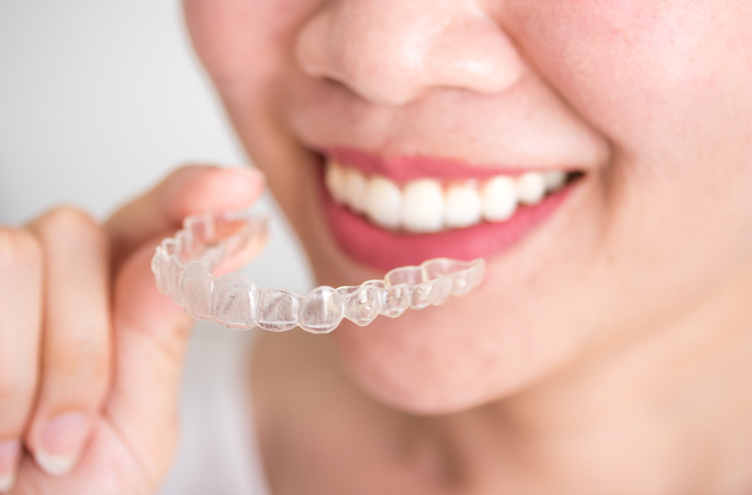 clear aligners